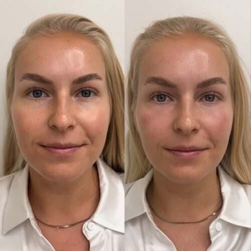 Alina voronkova botox kyynelurien taytto
