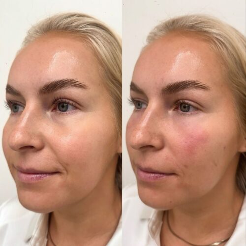Alina voronkova botox tayteainehoito