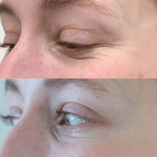 BOTOX Helsinki, ennen ja jälkeen, harakanvarpaat a