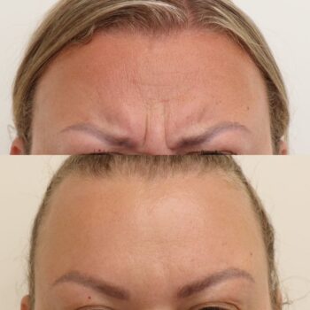 Kuinka nopeasti botox alkaa vaikuttaa