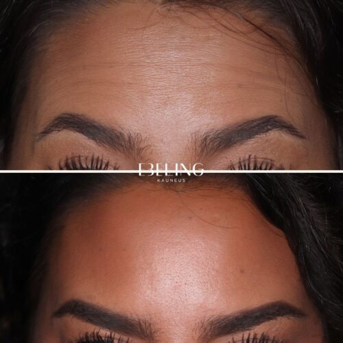 Botox Ebeling