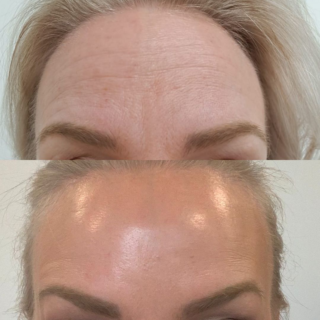 Botox Helsinki