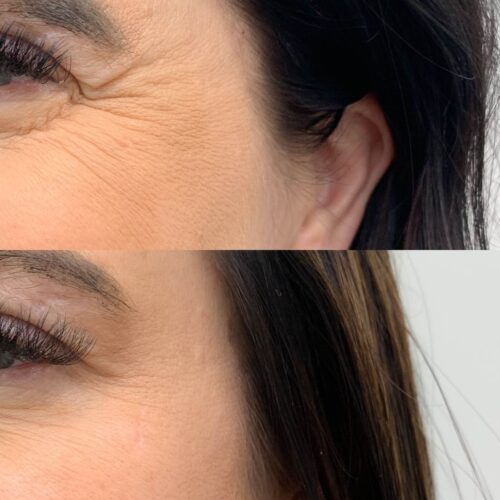Botox Helsinki, 2 harakanvarpaat ennen ja jälkeen