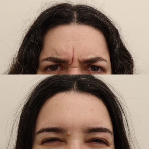 Botox Helsinki ennen ja jälkeen