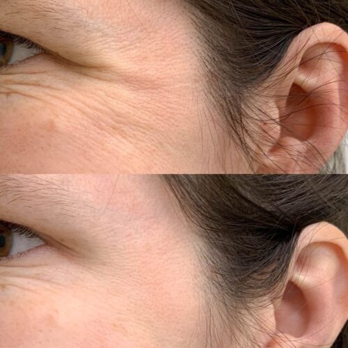 Botox Helsinki, ennen ja jälkeen, harakanvarpaat (2)