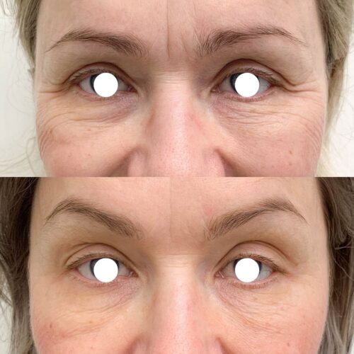 Botox Helsinki, ennen ja jälkeen, harakanvarpaat (3)