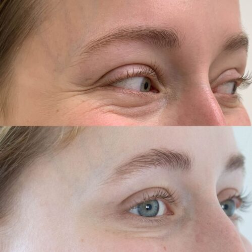 Botox Helsinki, ennen ja jälkeen, harakanvarpaat