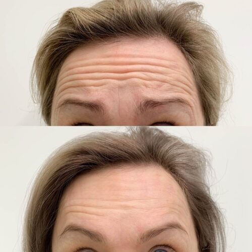 Botox Helsinki, ennen ja jälkeen, otsa