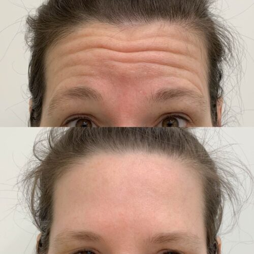 Botox Helsinki, ennen ja jälkeen, otsa ääriasennot