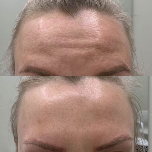 Botox Helsinki, ennen ja jälkeen, otsan vaakarypyt