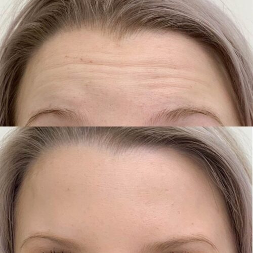 Botox Helsinki, ennen ja jälkeen, sibeliusryppy (2)