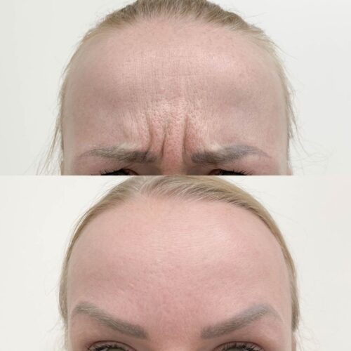 Botox Helsinki, ennen ja jälkeen, sibeliusryppy