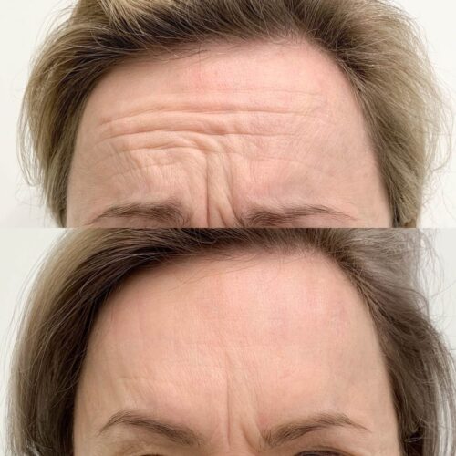 Botox Helsinki, ennen jälkeen botox hinta