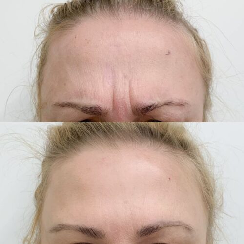 Botox Helsinki, ennen ja jälkeen, sibeliusrypyt (3)