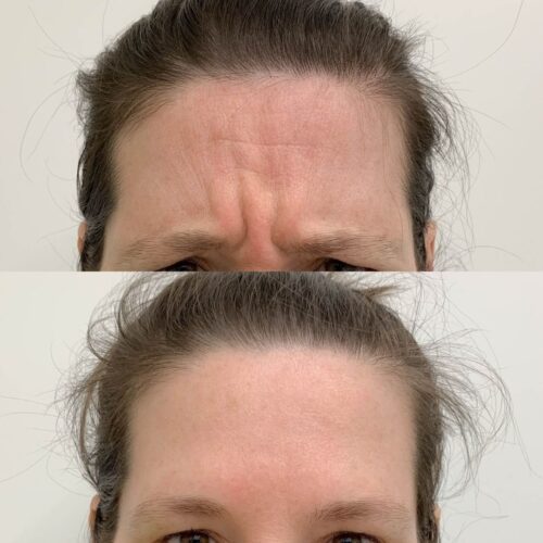 Botox Helsinki, ennen ja jälkeen, sibeliusrypyt