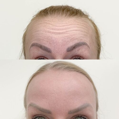 Botox Helsinki, ennen ja jälkeen, vaakarypyt, otsa