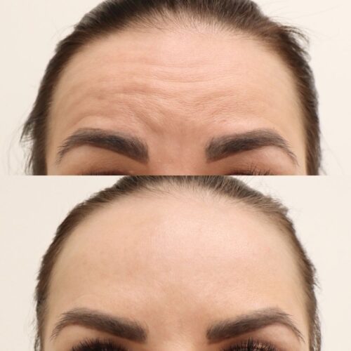 Botox Helsinki ennen jälkeen (2)