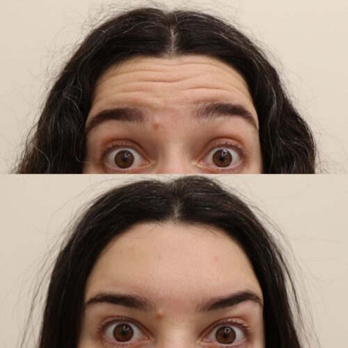 Botox Helsinki ennen jälkeen