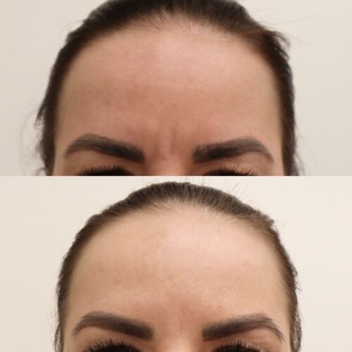 Botox Helsinki ennen jälkeen