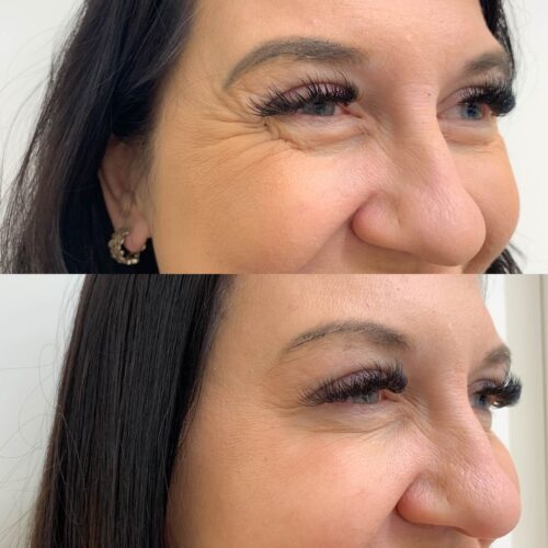 Botox Helsinki, harakanvarpaat ennen ja jälkeen