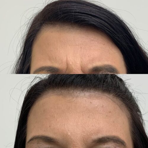 Botox Helsinki, sibeliusryppy ennen ja jälkeen