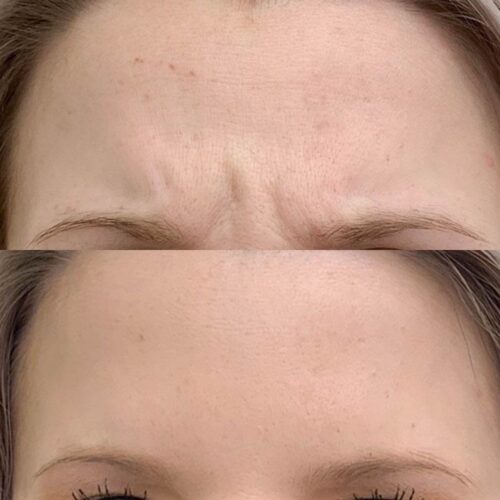 Botox Helsinki, sibeliusryppy, ennen ja jälkeen, sibeliusryppy