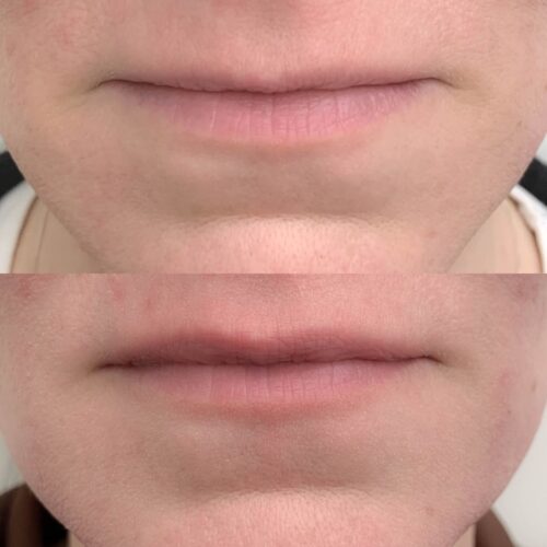 Botox Lip Flip Helsinki, ennen ja jälkeen