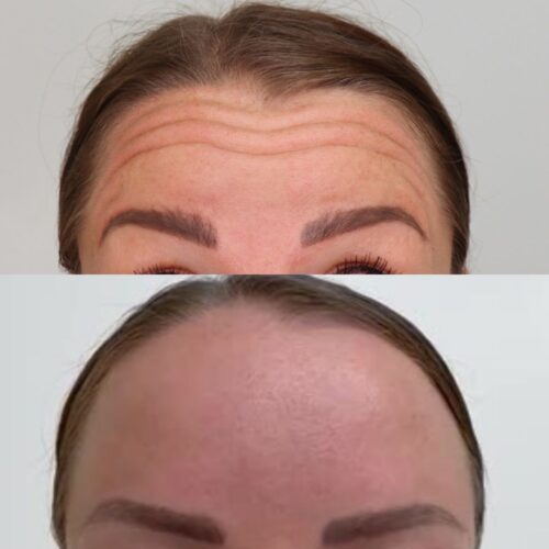 Botox ennen jälkeen