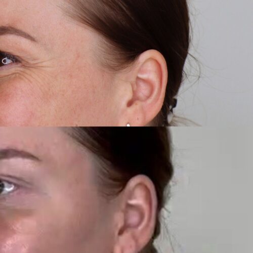 Botox harakanvarpaat ennen jälkeen