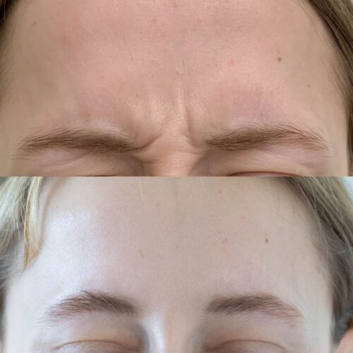 Botox hoito sibeliusryppy