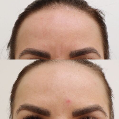 Botox iho