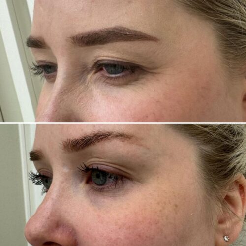Botox kulmien kohotus helsinki vantaa espoo (1)