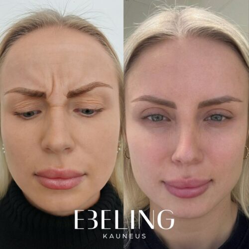 Botox otsa