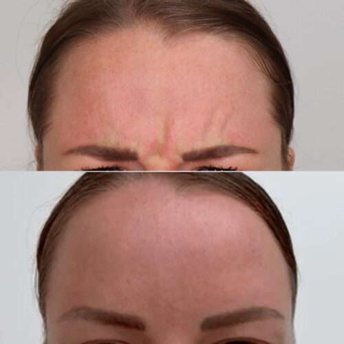 Botox otsa ennen jälkeen