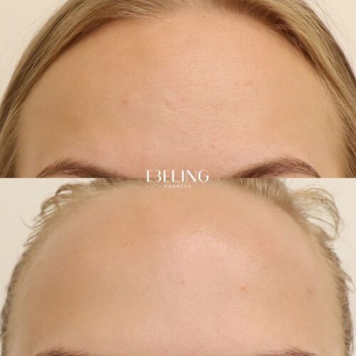 Botox otsaan rento ilme
