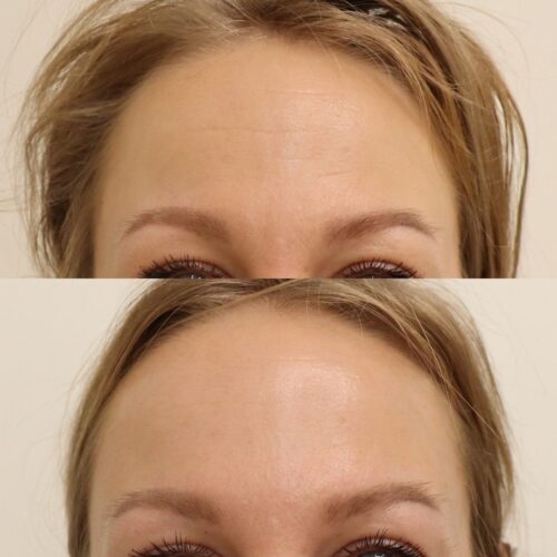 Botuliinihoito baby botox