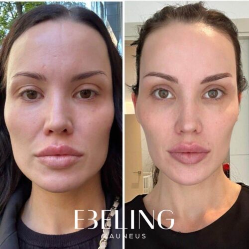 botox bruksismi botox helsinki