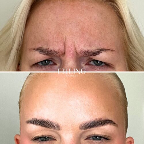 Ebeling botox kokemuksia
