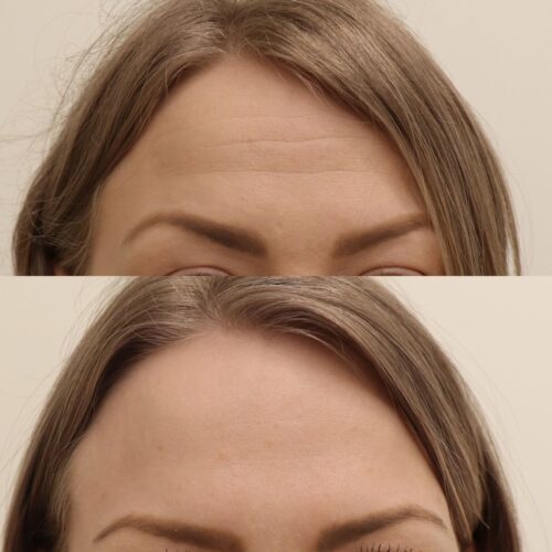 Emilia Sundqvist, Botox otsan vaakajuonteisiin (2)