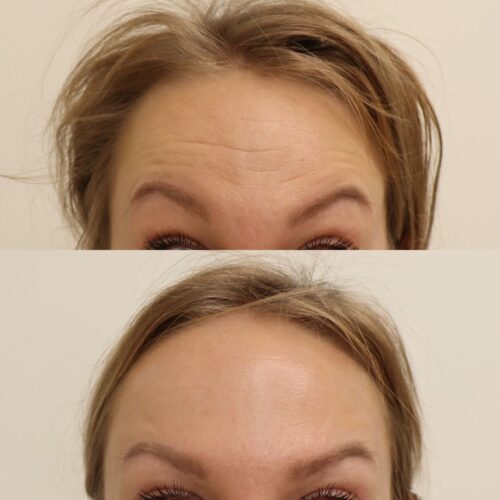 Emilia Sundqvist, Botox otsan vaakajuonteisiin
