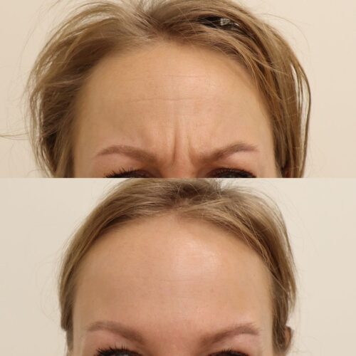 Emilia Sundqvist, Botox sibeliusryppyyn