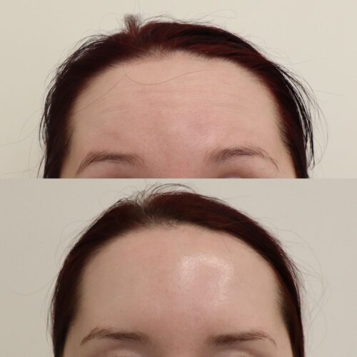 Emilia Sundqvist botox (2)