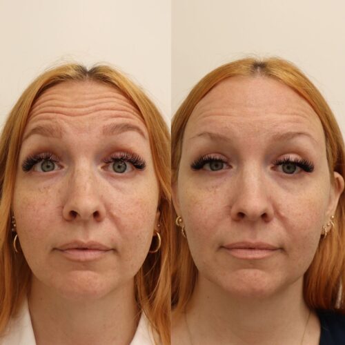 Emilia Sundqvist botox