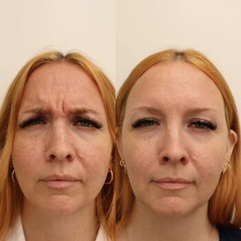 Botox-jälkihoito