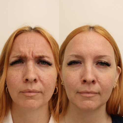 Emilia Sundqvist sibeliusryppy botox