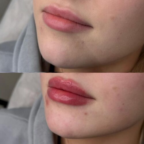 juvederm kokemuksia