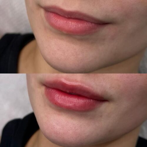 juvederm kokemuksia