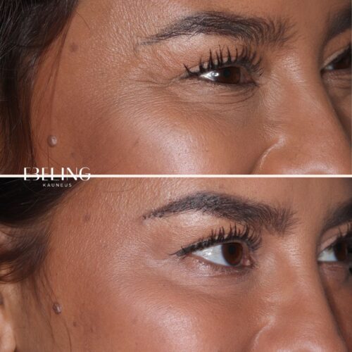 Erkki Ebeling botox harakanvarpaat