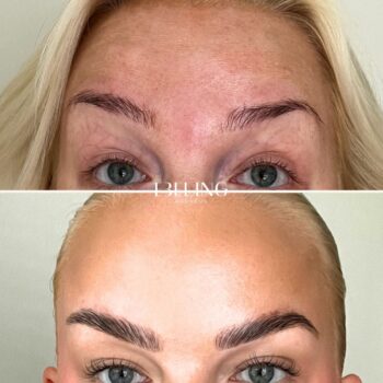 Botox-kokemuksia