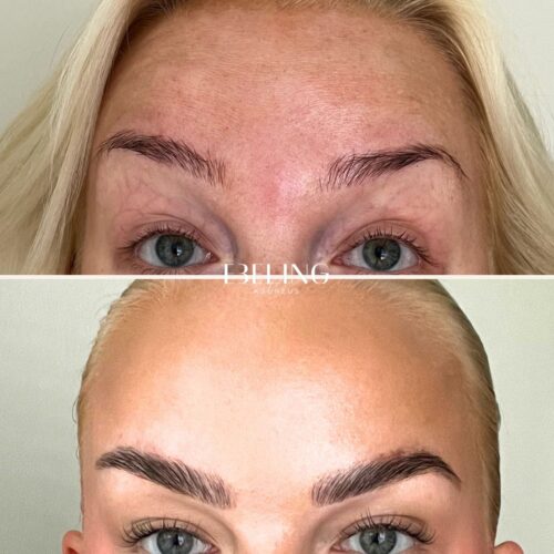Erkki ebeling botox kokemuksia
